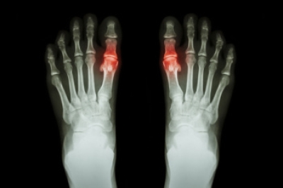 Risk Factors and Prevention of Gout