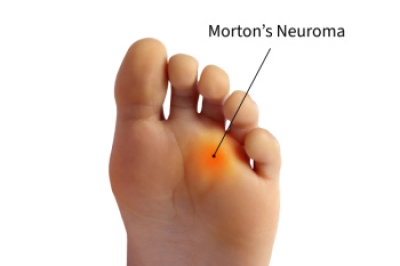 Understanding and Relieving Morton's Neuroma
